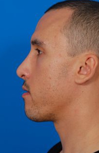 Male face, after Chin Implant treatment, l-side view of head, patient 94