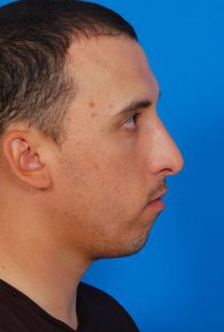 Male face, before Chin Implant treatment, r-side view of head, patient 94