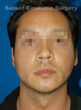 Male face, after Chin Implant treatment, front view, patient 8
