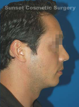 Male face, after Chin Implant treatment, r-side view, patient 8