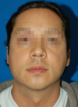 Male face, before Chin Implant treatment, front view, patient 8