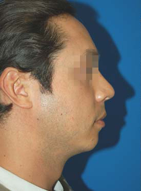 Male face, before Chin Implant treatment, r-side view, patient 8