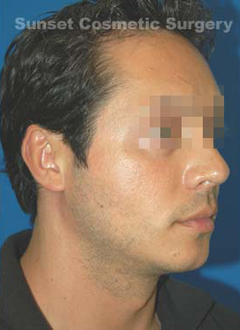 Male face, after Chin Implant treatment, r-side oblique view, patient 8
