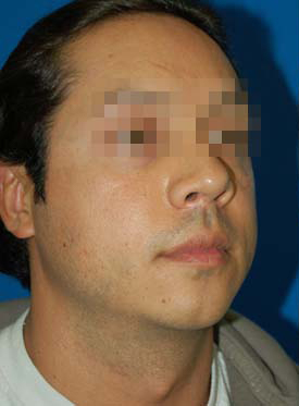 Male face, before Chin Implant treatment, r-side oblique view, patient 8