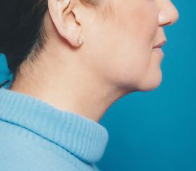 Female face, after Chin Implant treatment, r-side view, patient 2