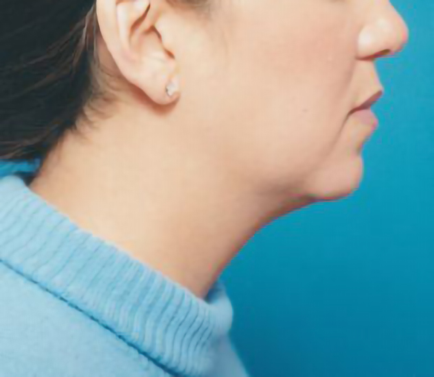 Female face, before Chin Implant treatment, r-side view, patient 2