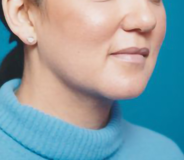 Female face, after Chin Implant treatment, r-side oblique view, patient 2