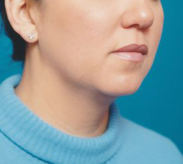 Female face, before Chin Implant treatment, r-side oblique view, patient 2