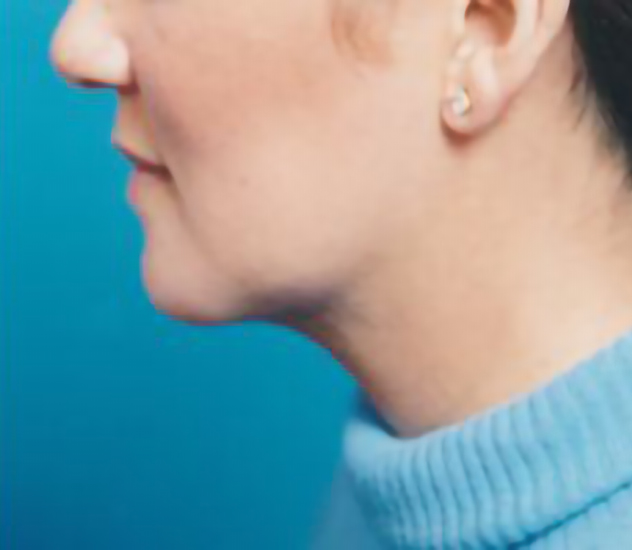 Female face, after Chin Implant treatment, l-side view, patient 2