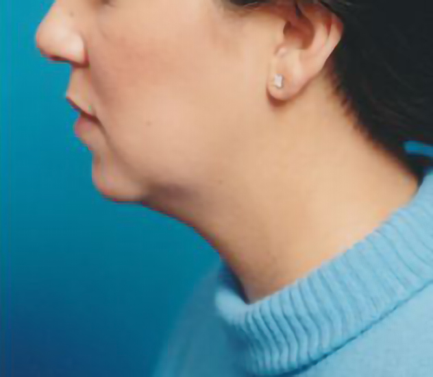 Female face, before Chin Implant treatment, l-side view, patient 2