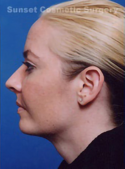 Female face, after Submental Lipocontouring treatment, l-side view