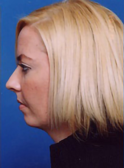 Female face, before Submental Lipocontouring treatment, l-side view