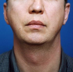 Male face, before Chin Implant treatment, front view, patient 5