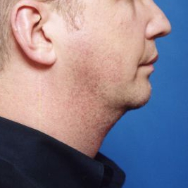 Male face, after Chin Implant treatment, r-side view, patient 5