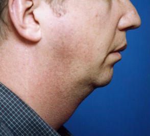 Male face, before Chin Implant treatment, r-side view, patient 5