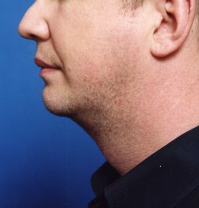 Male face, after Chin Implant treatment, l-side view, patient 5