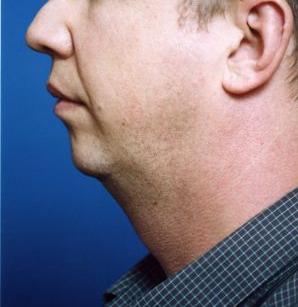 Male face, before Chin Implant treatment, l-side view, patient 5