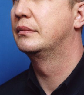 Male face, after Chin Implant treatment, l-side oblique view, patient 5