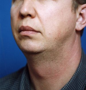 Male face, before Chin Implant treatment, l-side oblique view, patient 5