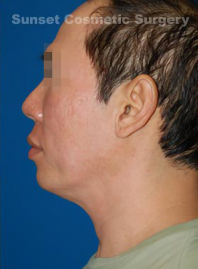 Male face, after Chin Implant treatment, l-side view, patient 6