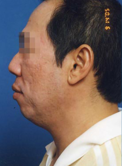 Male face, before Chin Implant treatment, l-side view, patient 6