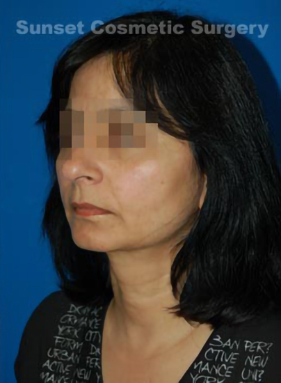 Female face, after Chin Implant treatment, l-side oblique view, patient 7