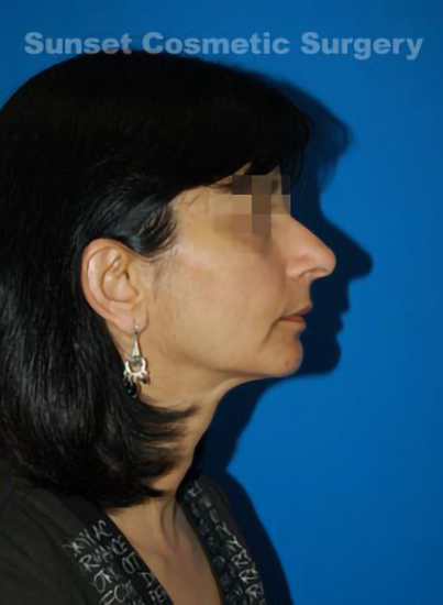 Female face, after Chin Implant treatment, r-side view, patient 7