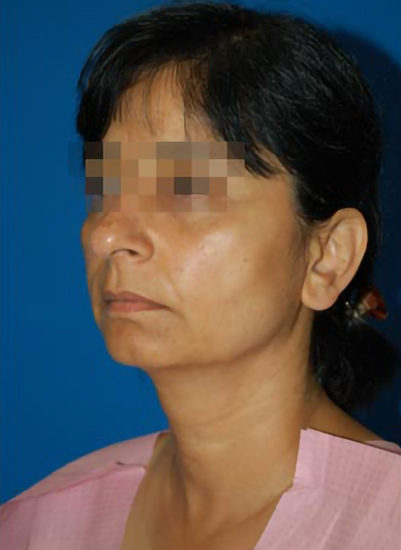 Female face, before Chin Implant treatment, l-side oblique view, patient 7