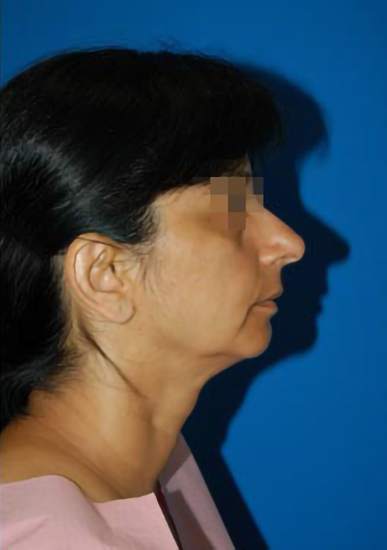 Female face, before Chin Implant treatment, r-side view, patient 7