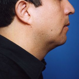 Male face, after Chin Implant treatment, r-side view, patient 9