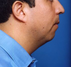 Male face, before Chin Implant treatment, r-side view, patient 9