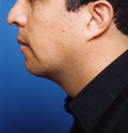 Male face, after Chin Implant treatment, l-side view, patient 9