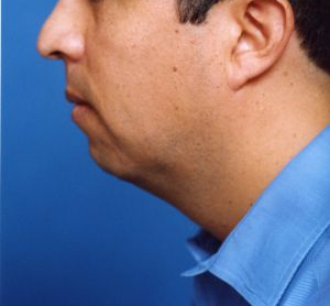 Male face, before Chin Implant treatment, l-side view, patient 9