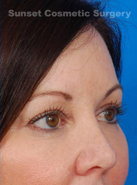 Woman's face, after Eyelid Surgery treatment, r-side oblique view, patient 1