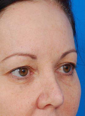 Woman's face, before Eyelid Surgery treatment, r-side oblique view, patient 1