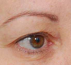 Woman's eye, before Eyelid Surgery treatment, r-side oblique view, patient 1