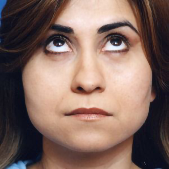 Woman's face, after Facial Fat Grafting treatment, front view (eyes looks up), patient 10