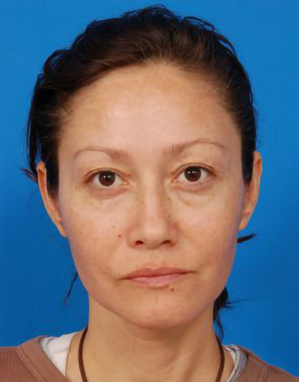 Woman's face, before Eyelid Surgery treatment, front view, patient 2