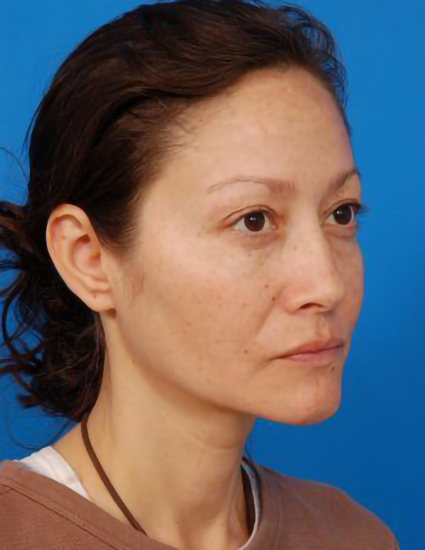 Woman's face, before Eyelid Surgery treatment, r-side oblique view, patient 2