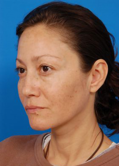 Woman's face, before Eyelid Surgery treatment, l-side oblique view, patient 2