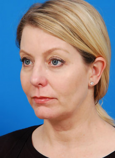 Woman's face, before Eyelid Surgery treatment, l-side oblique view, patient 3