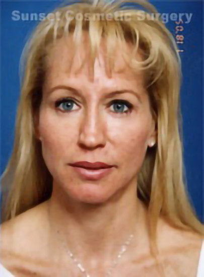 Woman's face, after Eyelid Surgery treatment, front view, patient 5