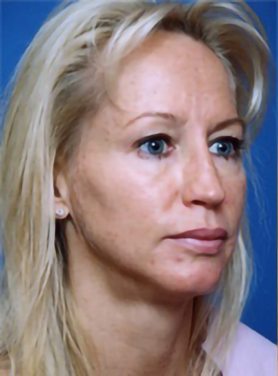 Woman's face, before Eyelid Surgery treatment, r-side oblique view, patient 5