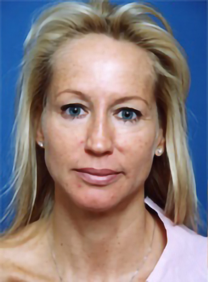 Woman's face, before Eyelid Surgery treatment, front view, patient 5