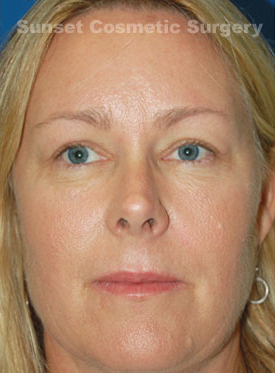 Woman's face, after Eyelid Surgery treatment, front view, patient 6