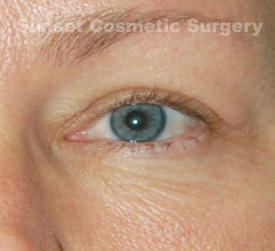 Woman's eye, after Eyelid Surgery treatment, front view, patient 6