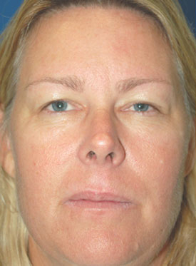 Woman's face, before Eyelid Surgery treatment, front view, patient 6