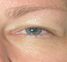 Woman's eye, before Eyelid Surgery treatment, front view, patient 6