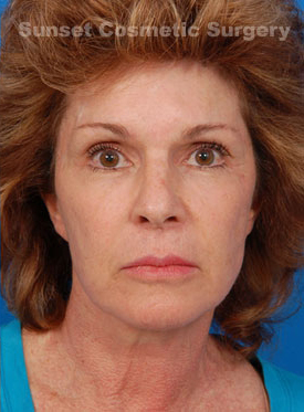 Woman's face, after Facelift treatment, front view, patient 2