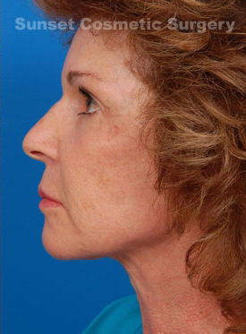 Woman's face, after Facelift treatment, l-side view, patient 2